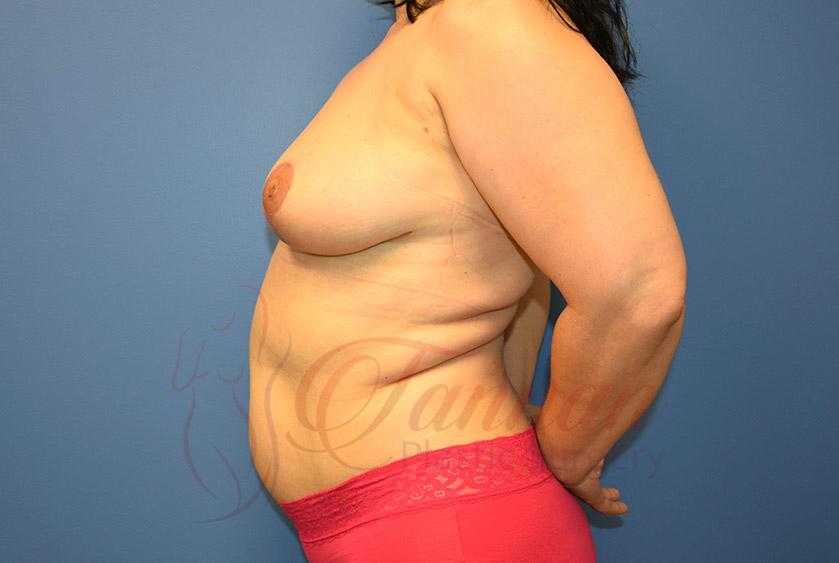 Tannan Plastic Surgery breast lift after — Raleigh, NC