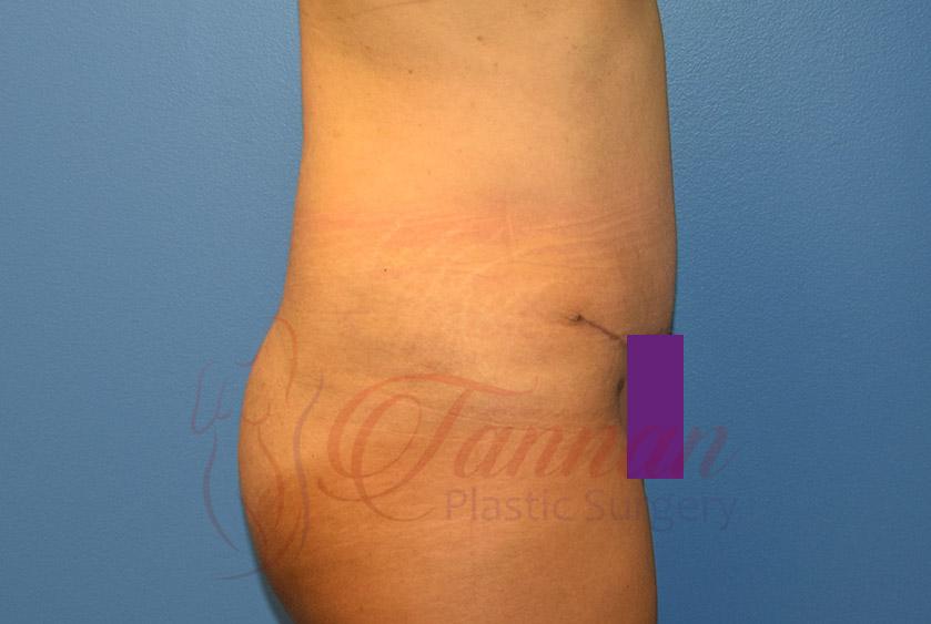 Tannan Plastic Surgery tummy tuck after — Raleigh, NC