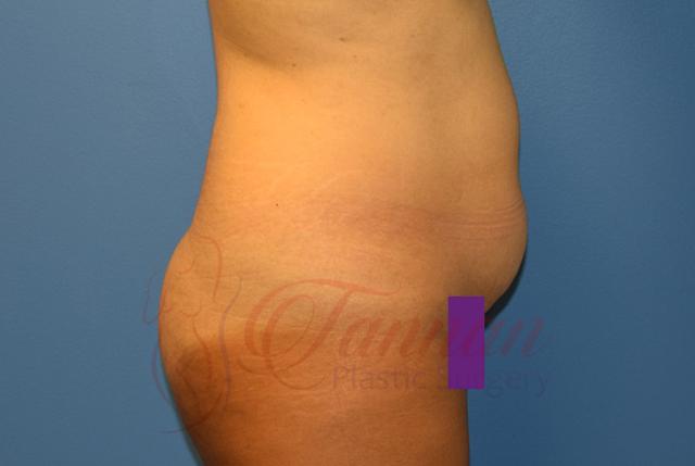 Tummy Tuck before at Tannan Plastic Surgery in Raleigh, NC