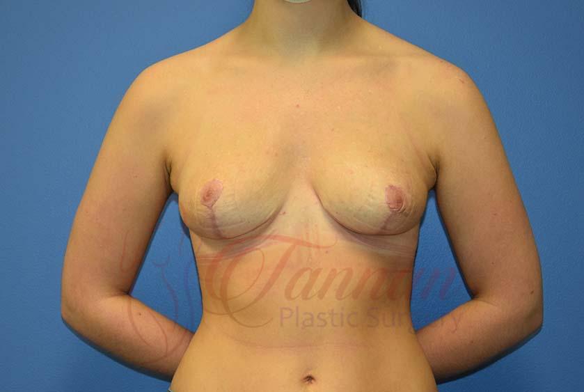 Tannan Plastic Surgery breast augmentation after — Raleigh, NC