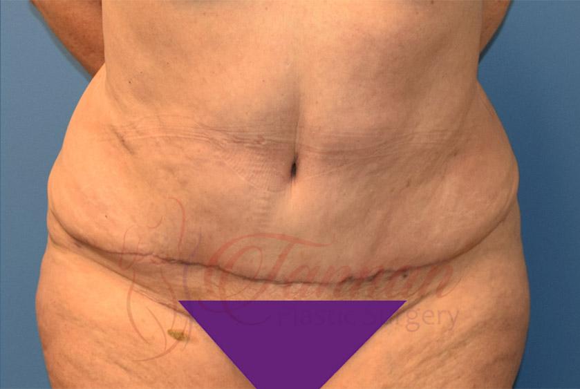 Tannan Plastic Surgery tummy tuck after — Raleigh, NC