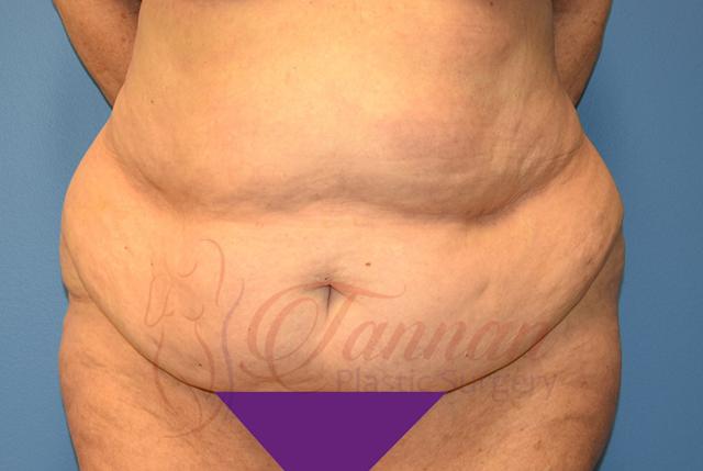 Tummy Tuck before at Tannan Plastic Surgery in Raleigh, NC