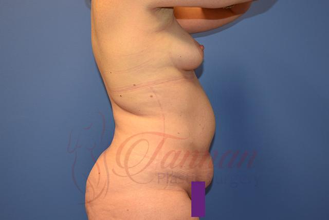Mommy Makeover before at Tannan Plastic Surgery in Raleigh, NC