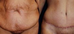 Sabrina Lahiri, MD Lahiri Plastic Surgery tummy tuck result — Shenandoah, TX