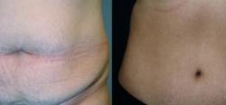 Sabrina Lahiri, MD Lahiri Plastic Surgery tummy tuck result — Shenandoah, TX