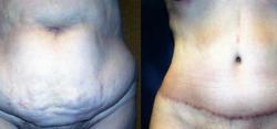 Sabrina Lahiri, MD Lahiri Plastic Surgery tummy tuck result — Shenandoah, TX