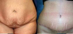 Mini Tummy Tuck result at Sabrina Lahiri, MD Lahiri Plastic Surgery in Shenandoah, TX
