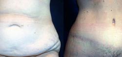 Sabrina Lahiri, MD Lahiri Plastic Surgery tummy tuck result — Shenandoah, TX