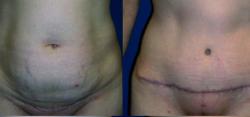 Sabrina Lahiri, MD Lahiri Plastic Surgery tummy tuck result — Shenandoah, TX