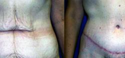 Sabrina Lahiri, MD Lahiri Plastic Surgery tummy tuck result — Shenandoah, TX