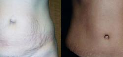 Sabrina Lahiri, MD Lahiri Plastic Surgery tummy tuck result — Shenandoah, TX
