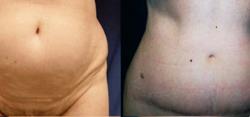 Sabrina Lahiri, MD Lahiri Plastic Surgery tummy tuck result — Shenandoah, TX