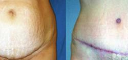 Sabrina Lahiri, MD Lahiri Plastic Surgery tummy tuck result — Shenandoah, TX