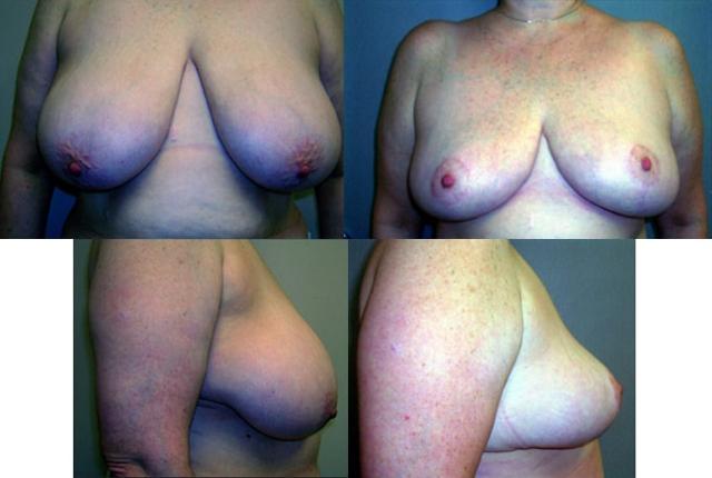 Breast Reduction result at Sabrina Lahiri, MD Lahiri Plastic Surgery in Shenandoah, TX