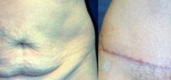 Sabrina Lahiri, MD Lahiri Plastic Surgery tummy tuck result — Shenandoah, TX