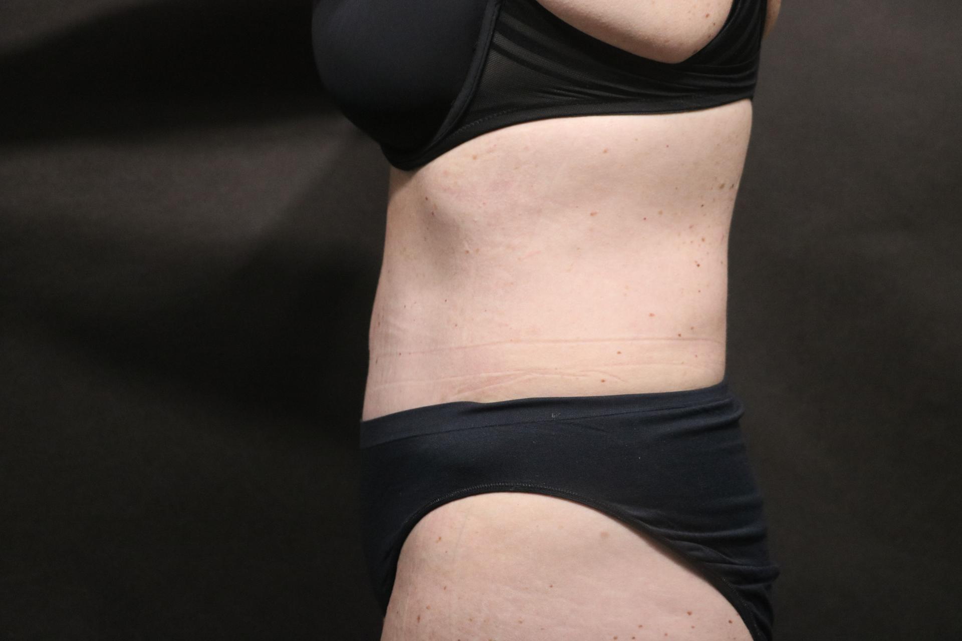 Korman Plastic Surgery & Wunderbar Medspa tummy tuck after — San Jose, CA