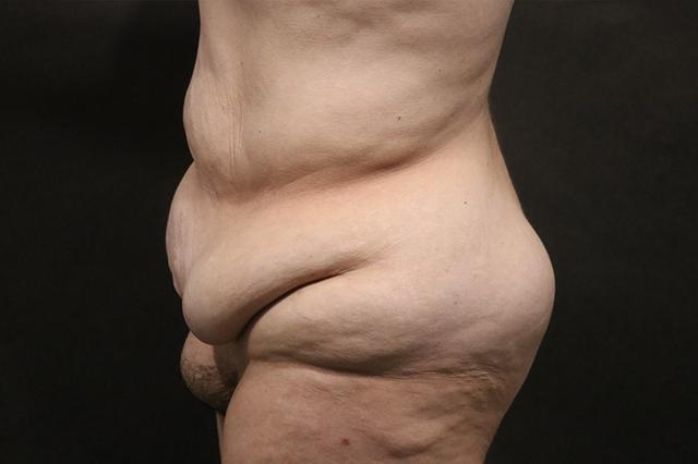Tummy Tuck before at Korman Plastic Surgery & Wunderbar Medspa in San Jose, CA