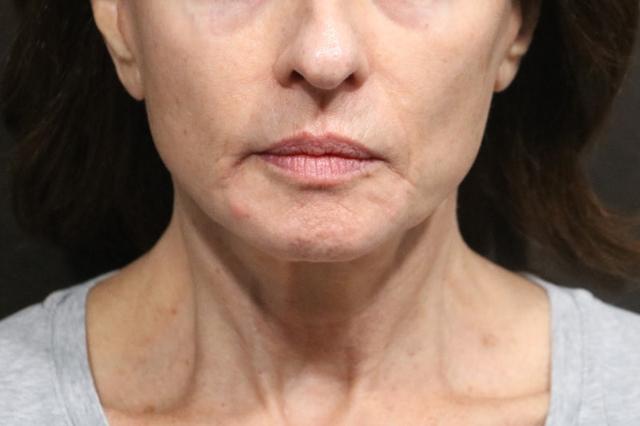 Deep Plane Facelift after at Korman Plastic Surgery & Wunderbar Medspa in San Jose, CA