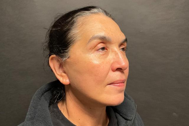 Deep Plane Facelift after at Korman Plastic Surgery & Wunderbar Medspa in San Jose, CA
