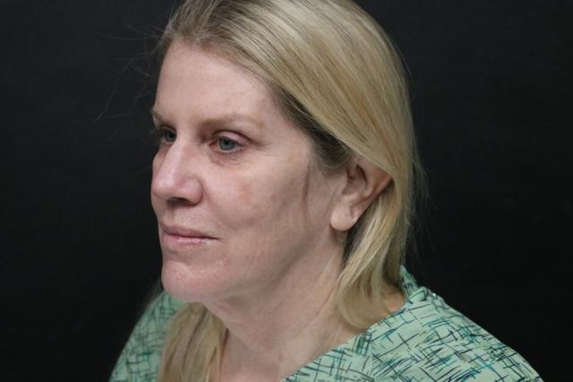 Deep Plane Facelift before at Korman Plastic Surgery & Wunderbar Medspa in San Jose, CA