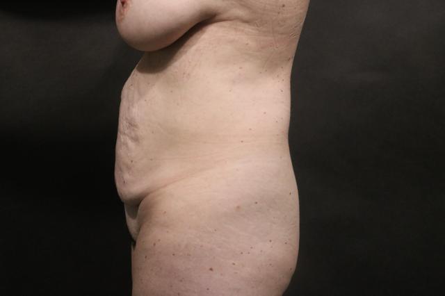 Tummy Tuck before at Korman Plastic Surgery & Wunderbar Medspa in San Jose, CA