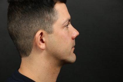 Korman Plastic Surgery & Wunderbar Medspa chin implant after — San Jose, CA