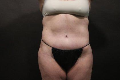 Korman Plastic Surgery & Wunderbar Medspa tummy tuck after — San Jose, CA