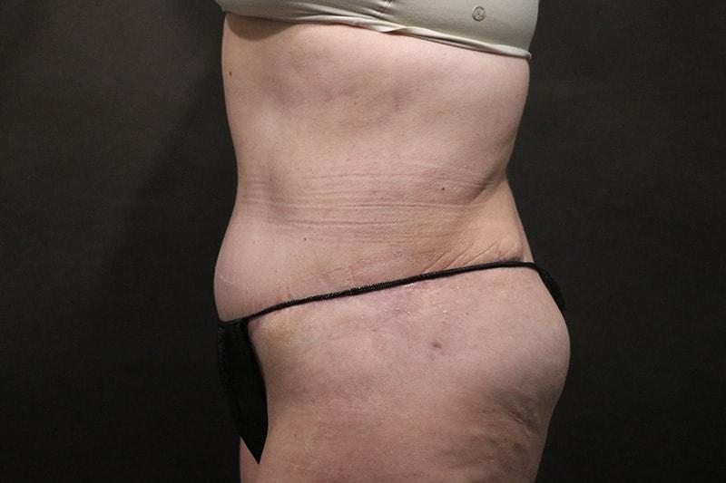 Korman Plastic Surgery & Wunderbar Medspa tummy tuck after — San Jose, CA
