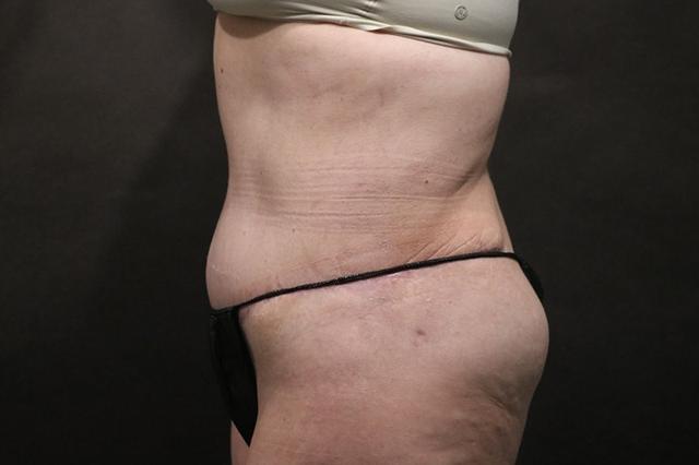 Tummy Tuck after at Korman Plastic Surgery & Wunderbar Medspa in San Jose, CA