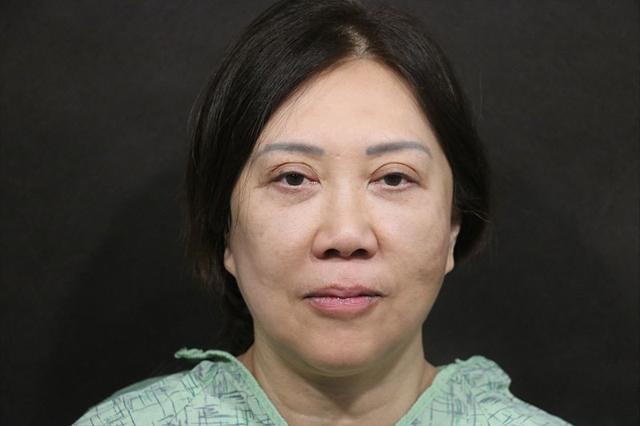 Deep Plane Facelift before at Korman Plastic Surgery & Wunderbar Medspa in San Jose, CA