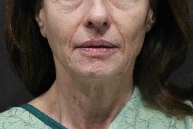 Deep Plane Facelift before at Korman Plastic Surgery & Wunderbar Medspa in San Jose, CA