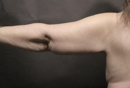 Korman Plastic Surgery & Wunderbar Medspa arm lift after — San Jose, CA