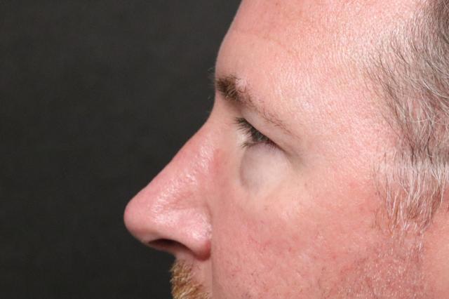 Rhinoplasty after at Korman Plastic Surgery & Wunderbar Medspa in San Jose, CA