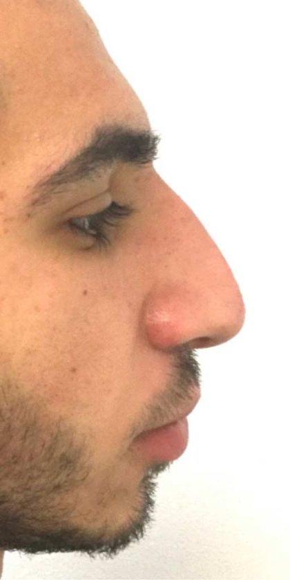 Lip Filler after at Korman Plastic Surgery & Wunderbar Medspa in San Jose, CA
