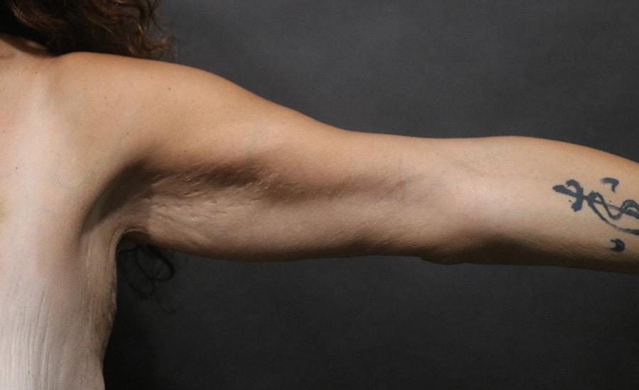 Korman Plastic Surgery & Wunderbar Medspa arm lift after — San Jose, CA