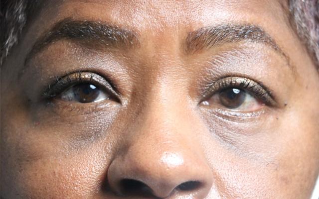 Blepharoplasty after at Korman Plastic Surgery & Wunderbar Medspa in San Jose, CA