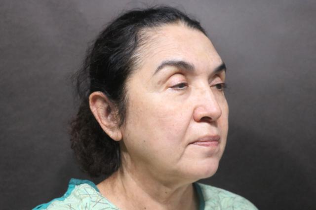 Deep Plane Facelift before at Korman Plastic Surgery & Wunderbar Medspa in San Jose, CA