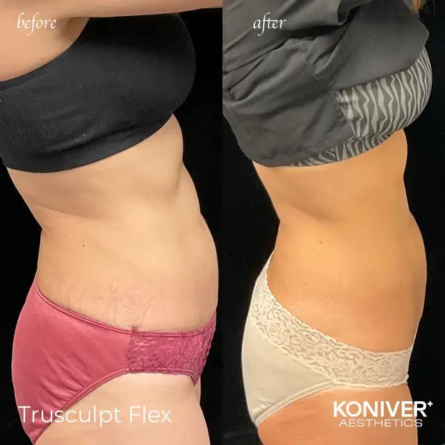 CoolSculpting result at Well Labs+ Medspa Charleston in Charleston, SC