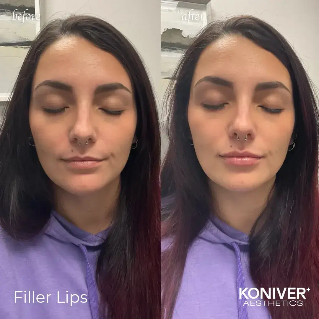 Well Labs+ Medspa Charleston lip filler result — Charleston, SC