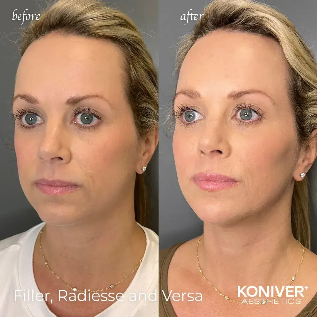 Well Labs+ Medspa Charleston lip filler result — Charleston, SC