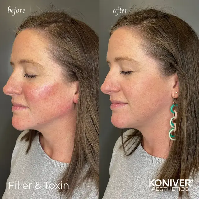 Lip Filler result at Well Labs+ Medspa Charleston in Charleston, SC