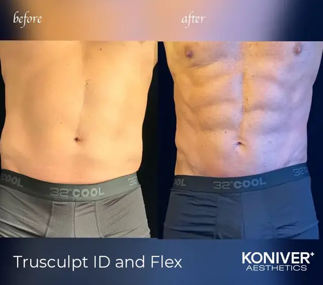 CoolSculpting result at Well Labs+ Medspa Charleston in Charleston, SC