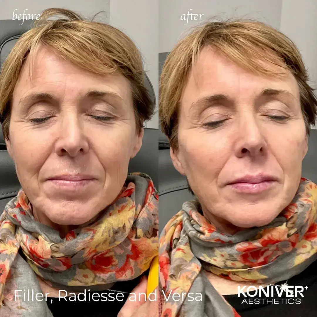 Well Labs+ Medspa Charleston lip filler result — Charleston, SC