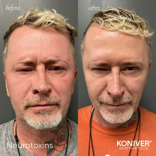 Botox result at Well Labs+ Medspa Charleston in Charleston, SC