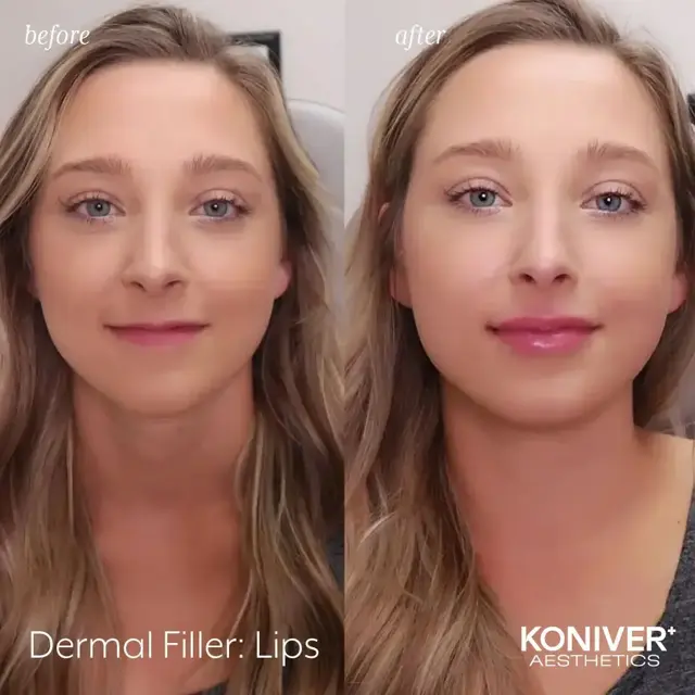 Lip Filler result at Well Labs+ Medspa Charleston in Charleston, SC