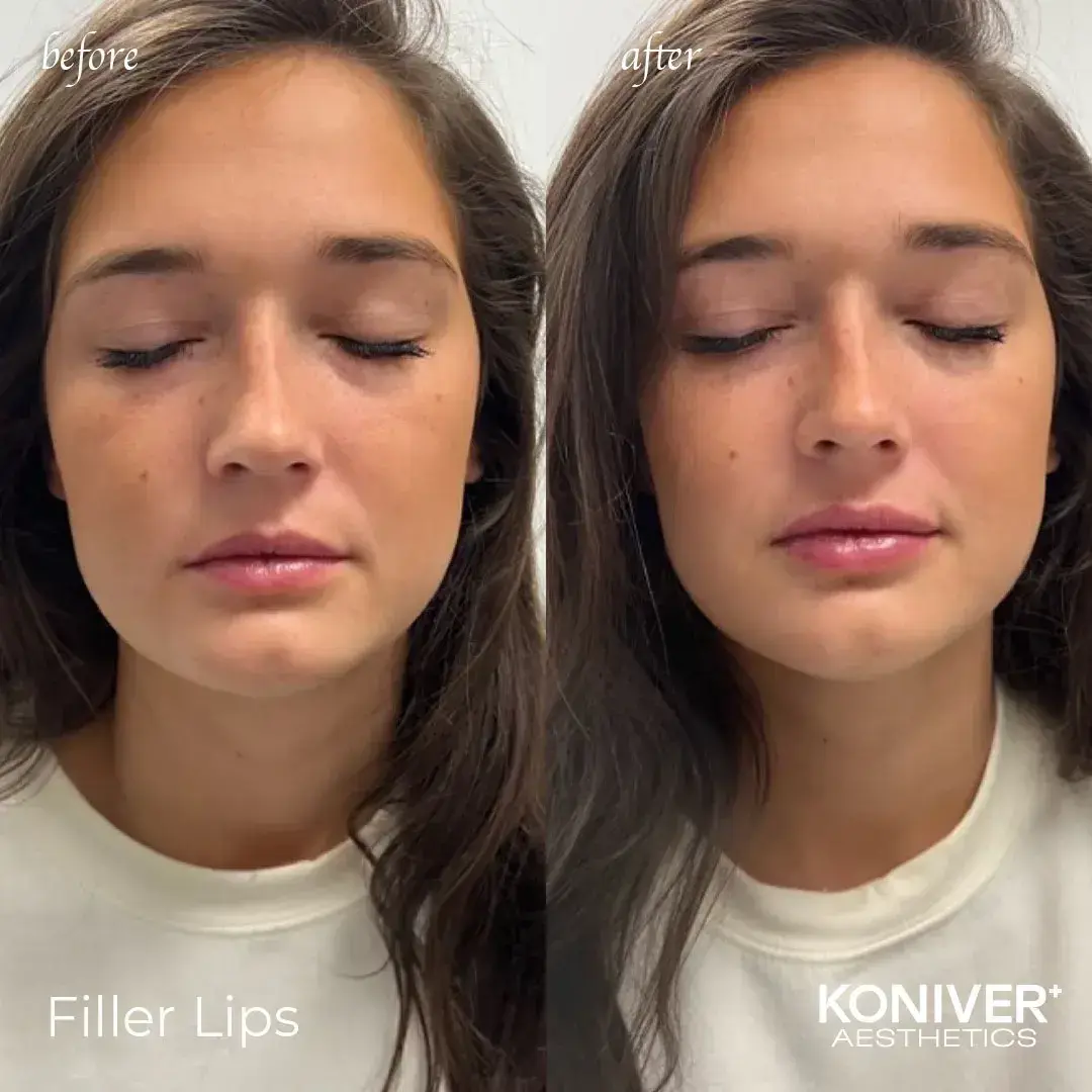 Well Labs+ Medspa Charleston lip filler result — Charleston, SC