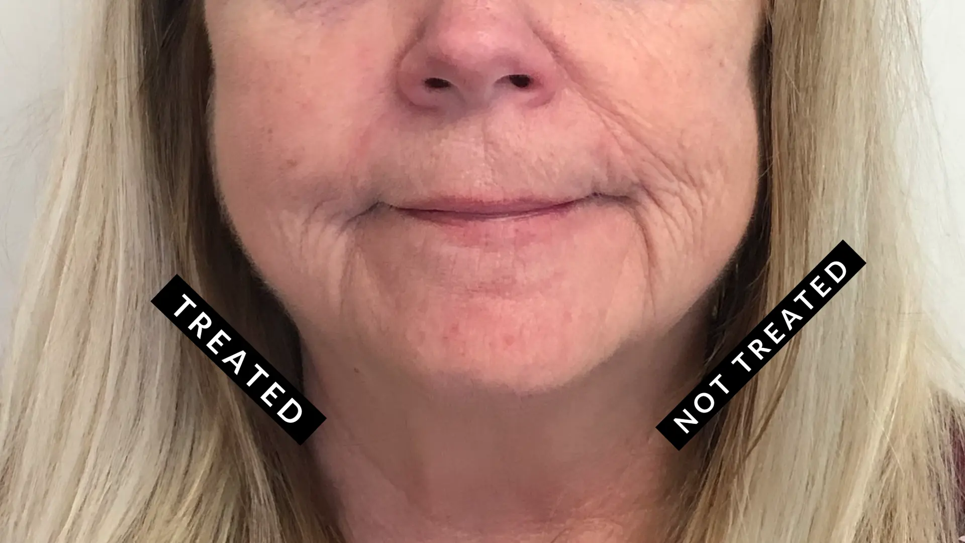 Dr. Hong Med Spa result — Newton, MA