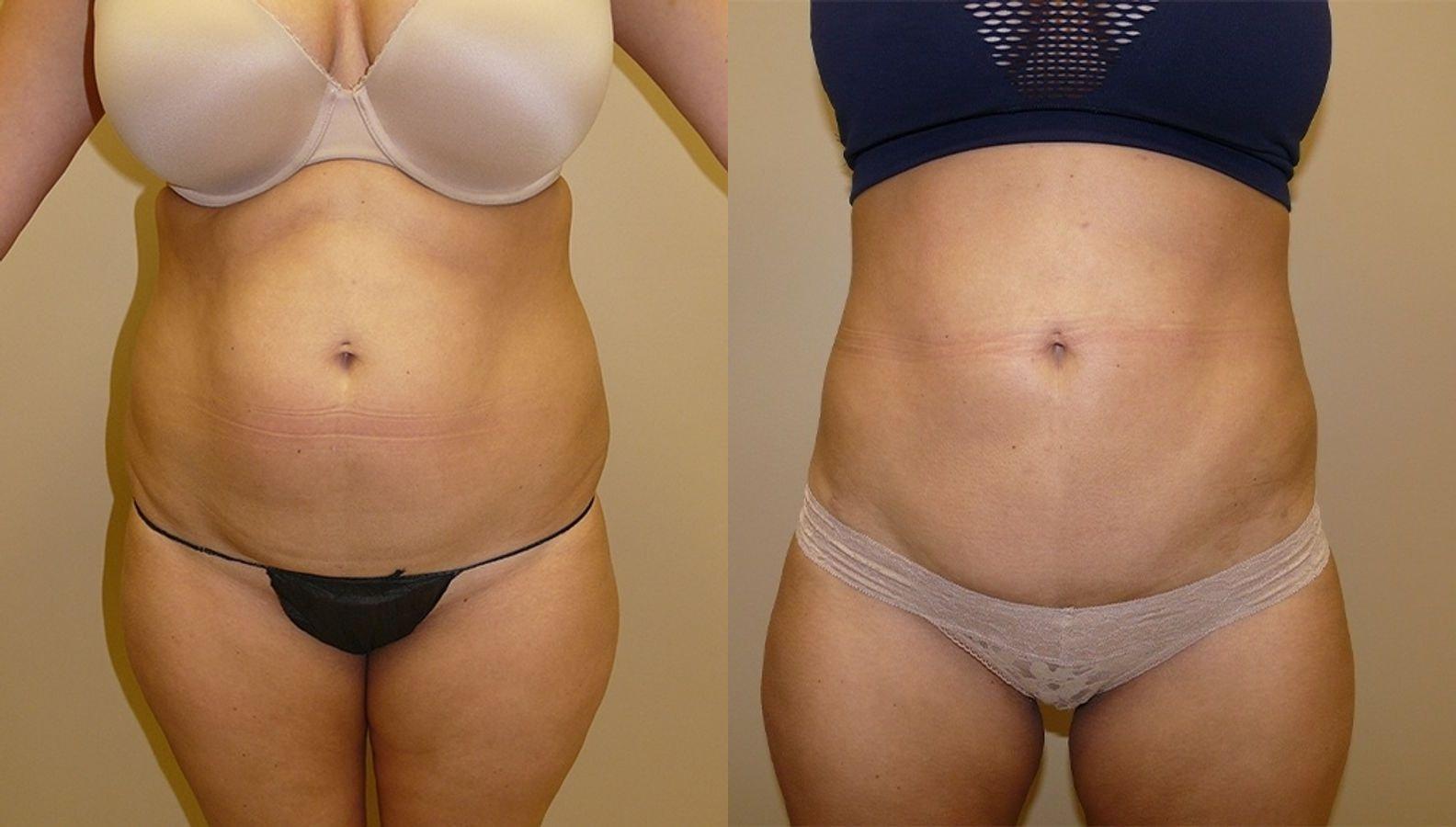 Palms Wellington Plastic Surgery (Itzhak Nir, MD) liposuction result — Loxahatchee, FL