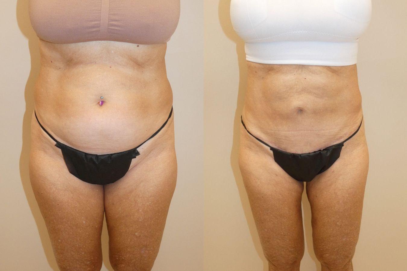 Palms Wellington Plastic Surgery (Itzhak Nir, MD) liposuction result — Loxahatchee, FL
