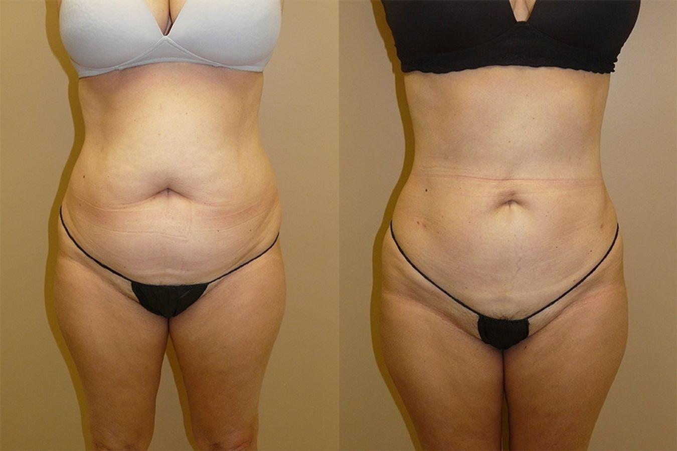 Palms Wellington Plastic Surgery (Itzhak Nir, MD) liposuction result — Loxahatchee, FL